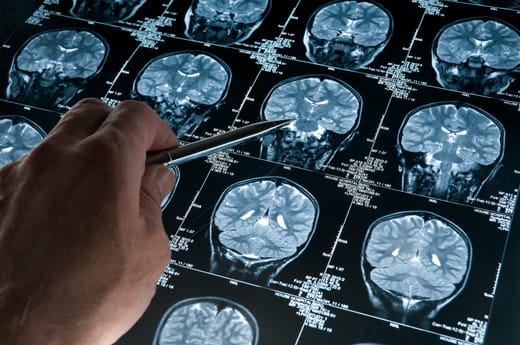 Sante-alzheimer-scan-cerveau